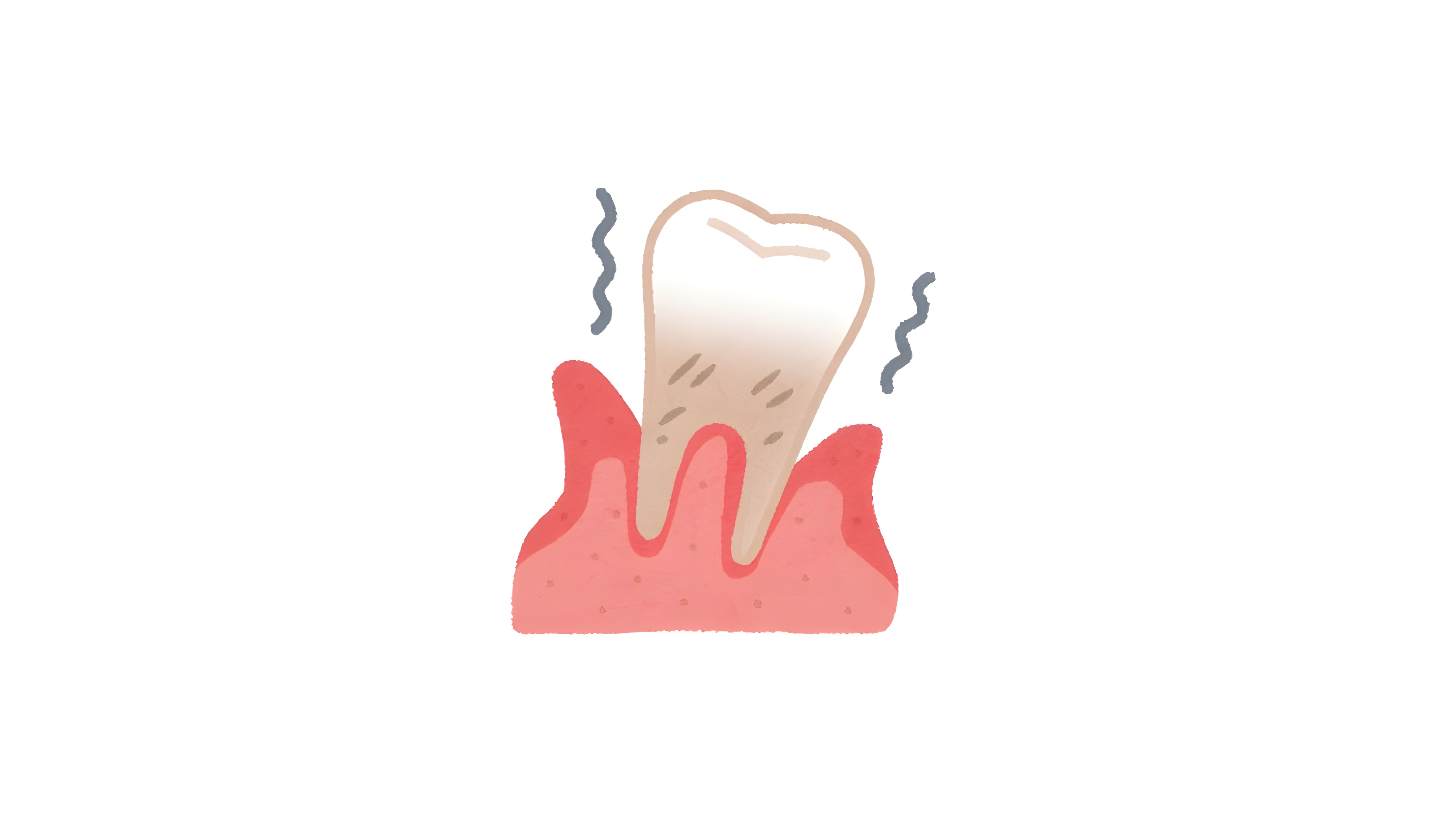 Thérapeutiques parodontales étiologiques