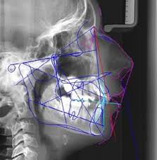 Dysmorphoses et malocclusions 
